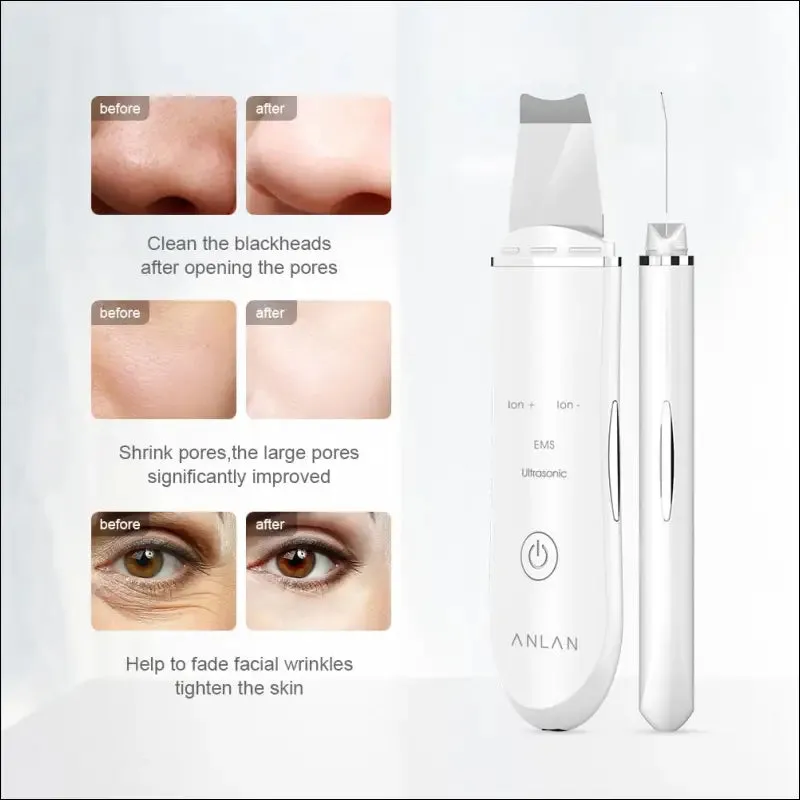 Anlan ultrasonic skin scrubber deep face cleaning machine peeling shovel facial pore cleaner face