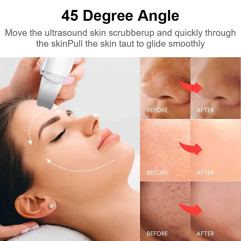 Ultrasonic Skin Scrubber - Blackhead Remover Spatula